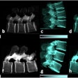 Lateral conventional attenuation (a, b, e, f) and co-registered dark-field (c, d, g, h) images of two spine specimens. Vertical (a, c, e, g) and horizontal (b, d, f, h) scans of the spine specimen of a 77-year-old female with osteoporosis (bone mineral density = 65.75 mg/dL) (a–d) and a non-osteoporotic spine specimen (e–h) of a 61-year-old female (bone mineral density = 169.38 mg/dL).