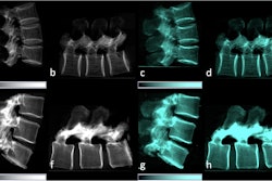 Lateral conventional attenuation (a, b, e, f) and co-registered dark-field (c, d, g, h) images of two spine specimens. Vertical (a, c, e, g) and horizontal (b, d, f, h) scans of the spine specimen of a 77-year-old female with osteoporosis (bone mineral density = 65.75 mg/dL) (a–d) and a non-osteoporotic spine specimen (e–h) of a 61-year-old female (bone mineral density = 169.38 mg/dL).