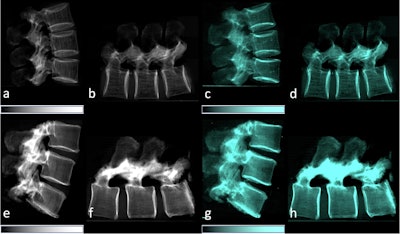 Lateral conventional attenuation (a, b, e, f) and co-registered dark-field (c, d, g, h) images of two spine specimens. Vertical (a, c, e, g) and horizontal (b, d, f, h) scans of the spine specimen of a 77-year-old female with osteoporosis (bone mineral density = 65.75 mg/dL) (a–d) and a non-osteoporotic spine specimen (e–h) of a 61-year-old female (bone mineral density = 169.38 mg/dL).