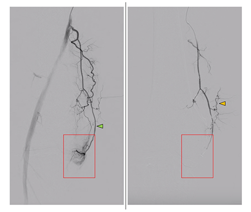 Peri-interventional digital subtraction angiography (DSA) of the descending genicular artery (DSA), a diagnostic procedure to view the inner surface of blood vessels, (green arrow) in a patient with symptomatic knee osteoarthritis of the right leg. On the left, the pre-interventional image with a clearly visible hyperemic blush (red box). On the right, the post-interventional DSA after embolization with Imepenem-Cilastatin. A completely eliminated blush is observed while preserving skin collaterals (orange arrows). Image courtesy of the RSNA.