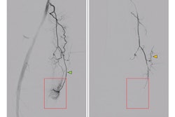 Peri-interventional digital subtraction angiography (DSA) of the descending genicular artery (DSA), a diagnostic procedure to view the inner surface of blood vessels, (green arrow) in a patient with symptomatic knee osteoarthritis of the right leg. On the left, the pre-interventional image with a clearly visible hyperemic blush (red box). On the right, the post-interventional DSA after embolization with Imepenem-Cilastatin. A completely eliminated blush is observed while preserving skin collaterals (orange arrows). Image courtesy of the RSNA.