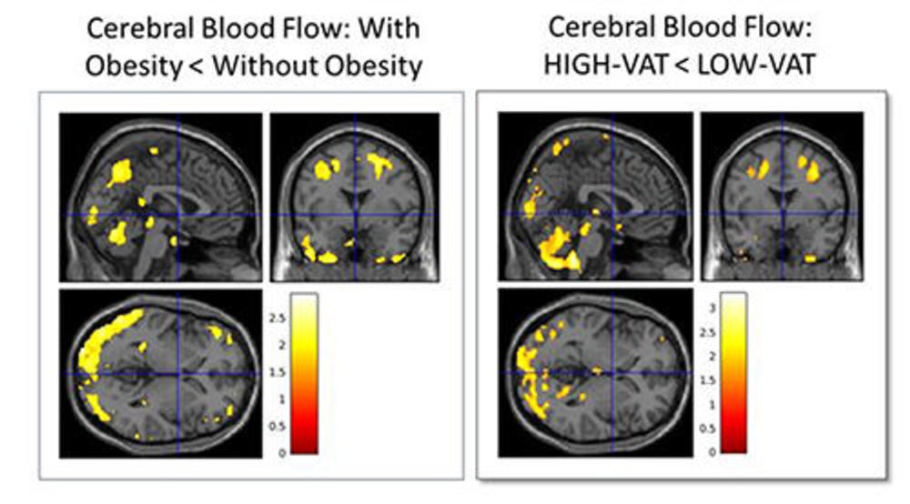 Comparison of cerebral blood flow in 65 cognitively normal midlife individuals showed that individuals with obesity and high visceral adipose tissue have reduced blood flow in the temporal and parietal regions of the brain. Images courtesy of the RSNA.