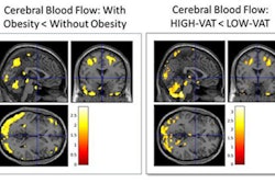 Comparison of cerebral blood flow in 65 cognitively normal midlife individuals showed that individuals with obesity and high visceral adipose tissue have reduced blood flow in the temporal and parietal regions of the brain. Images courtesy of the RSNA.