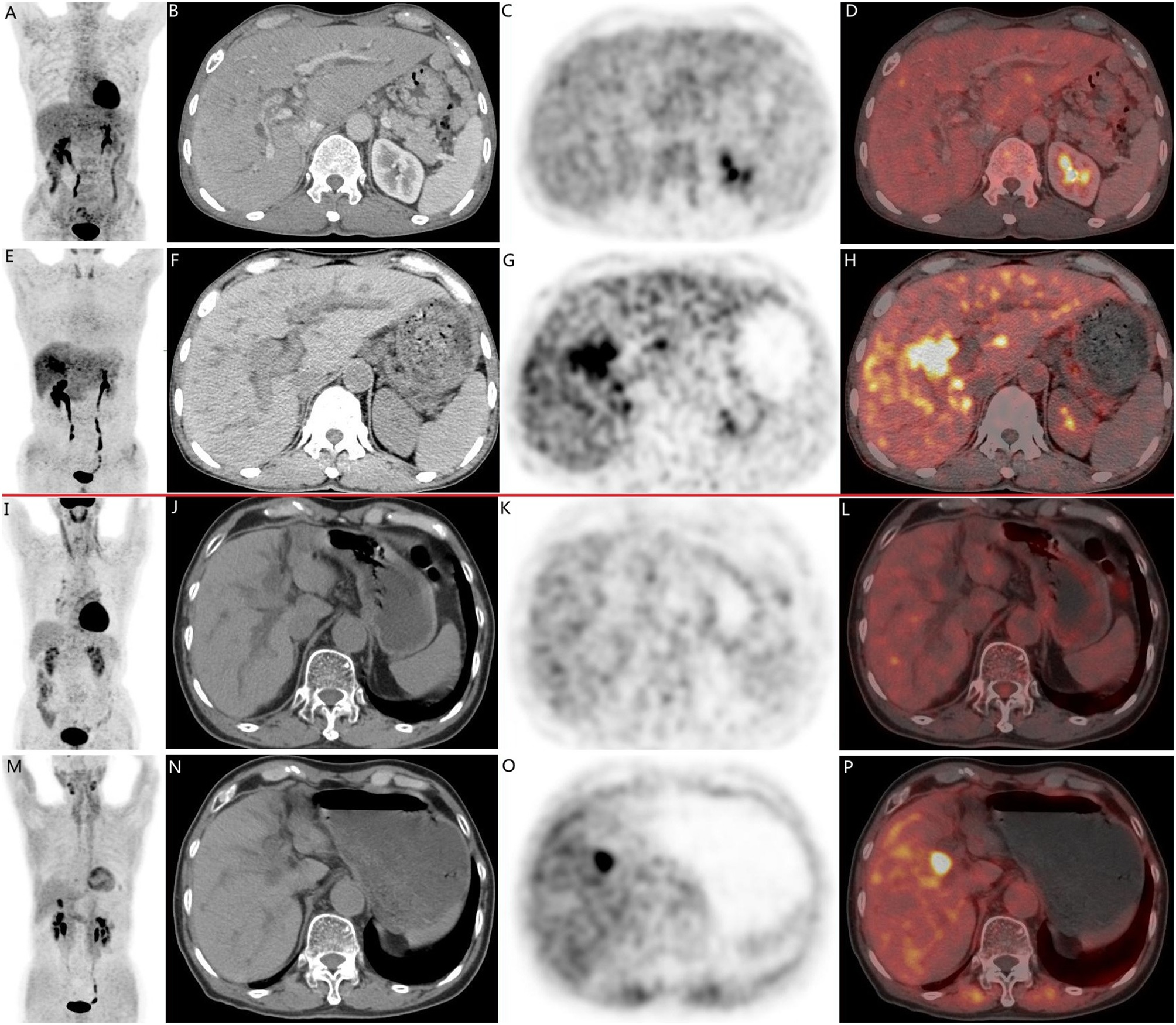 Two cases of pathologically confirmed intrahepatic cholangiocarcinomas in 68-year-old male patients. In both cases (A-H, case 1; I-P, case 2), CT scans (B, F, case 1; J, N, case 2) revealed intrahepatic bile duct dilation and suspected nodular lesions. While F-18 FDG PET/CT (A, C, D, case 1; I, K, L, case 2) failed to demonstrate abnormal tracer uptake (SUVmax 3.5, TBR 1.3 in Case 1; SUVmax 2.6, TBR 1.2 in Case 2), F-18 FAPI-04 PET/CT (E, G, H, case 1; M, O, P, case 2 ) showed positive uptake in the nodular lesions (SUVmax 9.7, TBR 3.5 in Case 1; SUVmax 9.6, TBR 3.3 in Case 2). Image available for republishing under Creative Commons license (CC BY 4.0 DEED, Attribution 4.0 International) and courtesy of BMC Cancer.
