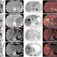 Two cases of pathologically confirmed intrahepatic cholangiocarcinomas in 68-year-old male patients. In both cases (A-H, case 1; I-P, case 2), CT scans (B, F, case 1; J, N, case 2) revealed intrahepatic bile duct dilation and suspected nodular lesions. While F-18 FDG PET/CT (A, C, D, case 1; I, K, L, case 2) failed to demonstrate abnormal tracer uptake (SUVmax 3.5, TBR 1.3 in Case 1; SUVmax 2.6, TBR 1.2 in Case 2), F-18 FAPI-04 PET/CT (E, G, H, case 1; M, O, P, case 2 ) showed positive uptake in the nodular lesions (SUVmax 9.7, TBR 3.5 in Case 1; SUVmax 9.6, TBR 3.3 in Case 2). Image available for republishing under Creative Commons license (CC BY 4.0 DEED, Attribution 4.0 International) and courtesy of BMC Cancer.