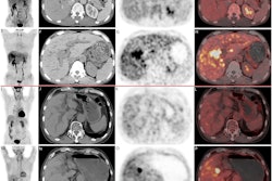 Two cases of pathologically confirmed intrahepatic cholangiocarcinomas in 68-year-old male patients. In both cases (A-H, case 1; I-P, case 2), CT scans (B, F, case 1; J, N, case 2) revealed intrahepatic bile duct dilation and suspected nodular lesions. While F-18 FDG PET/CT (A, C, D, case 1; I, K, L, case 2) failed to demonstrate abnormal tracer uptake (SUVmax 3.5, TBR 1.3 in Case 1; SUVmax 2.6, TBR 1.2 in Case 2), F-18 FAPI-04 PET/CT (E, G, H, case 1; M, O, P, case 2 ) showed positive uptake in the nodular lesions (SUVmax 9.7, TBR 3.5 in Case 1; SUVmax 9.6, TBR 3.3 in Case 2). Image available for republishing under Creative Commons license (CC BY 4.0 DEED, Attribution 4.0 International) and courtesy of BMC Cancer.
