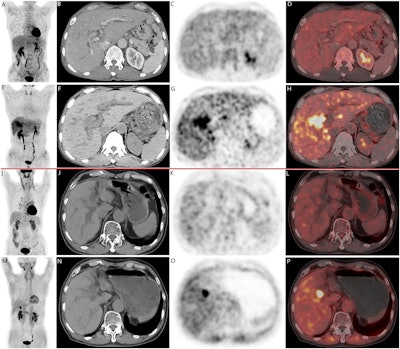 Two cases of pathologically confirmed intrahepatic cholangiocarcinomas in 68-year-old male patients. In both cases (A-H, case 1; I-P, case 2), CT scans (B, F, case 1; J, N, case 2) revealed intrahepatic bile duct dilation and suspected nodular lesions. While F-18 FDG PET/CT (A, C, D, case 1; I, K, L, case 2) failed to demonstrate abnormal tracer uptake (SUVmax 3.5, TBR 1.3 in Case 1; SUVmax 2.6, TBR 1.2 in Case 2), F-18 FAPI-04 PET/CT (E, G, H, case 1; M, O, P, case 2 ) showed positive uptake in the nodular lesions (SUVmax 9.7, TBR 3.5 in Case 1; SUVmax 9.6, TBR 3.3 in Case 2). Image available for republishing under Creative Commons license (CC BY 4.0 DEED, Attribution 4.0 International) and courtesy of BMC Cancer.