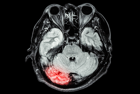 Mri Brain Disease1 Thumbnail