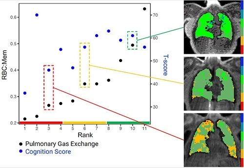 Individuals in the study were plotted with the x-axis being rank of pulmonary gas exchange. The black dots show the pulmonary gas exchange ratio (red blood cell to tissue plasma ratio, RBC:mem) on the left y-axis and the blue dots are the cognition scores on the right y-axis. Gas exchange maps of three representative patients from a low, medium, and high pulmonary gas exchange. Image courtesy of RSNA.