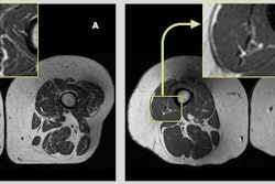 Axial T1-weighted bilateral thigh MR images and magnified frames providing a closer look at the areas in lateral aspects of quadriceps femoris muscles (knee extensors) from two obese, female participants, aged 58 (A) and 62 years (B), respectively. In A, the thigh muscles on both sides demonstrate abundant fatty streaks, consistent with a high Goutallier grade for this participant, whose diet from the past 12 months consisted of 68% ultraprocessed foods. In B, the thigh muscles show fewer fatty streaks as highlighted in the magnified image, consistent with a low Goutallier grade for this participant, whose diet contained only 36% ultraprocessed foods. Image courtesy of RSNA.
