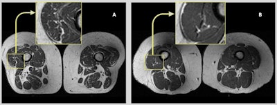 Axial T1-weighted bilateral thigh MR images and magnified frames providing a closer look at the areas in lateral aspects of quadriceps femoris muscles (knee extensors) from two obese, female participants, aged 58 (A) and 62 years (B), respectively. In A, the thigh muscles on both sides demonstrate abundant fatty streaks, consistent with a high Goutallier grade for this participant, whose diet from the past 12 months consisted of 68% ultraprocessed foods. In B, the thigh muscles show fewer fatty streaks as highlighted in the magnified image, consistent with a low Goutallier grade for this participant, whose diet contained only 36% ultraprocessed foods. Image courtesy of RSNA.