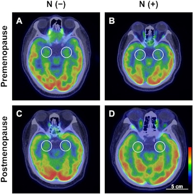 Representative images of metabolic activity in the amygdala (AmygA) of premenopausal patients (A,B) and postmenopausal patients (C,D), categorized by lymph node metastasis. The circular region of interest indicates the amygdala. N (−); negative LN metastasis, N (+); positive LN metastasis. Image available for republishing under Creative Commons license (CC BY 4.0 DEED, Attribution 4.0 International) and courtesy of Scientific Reports.