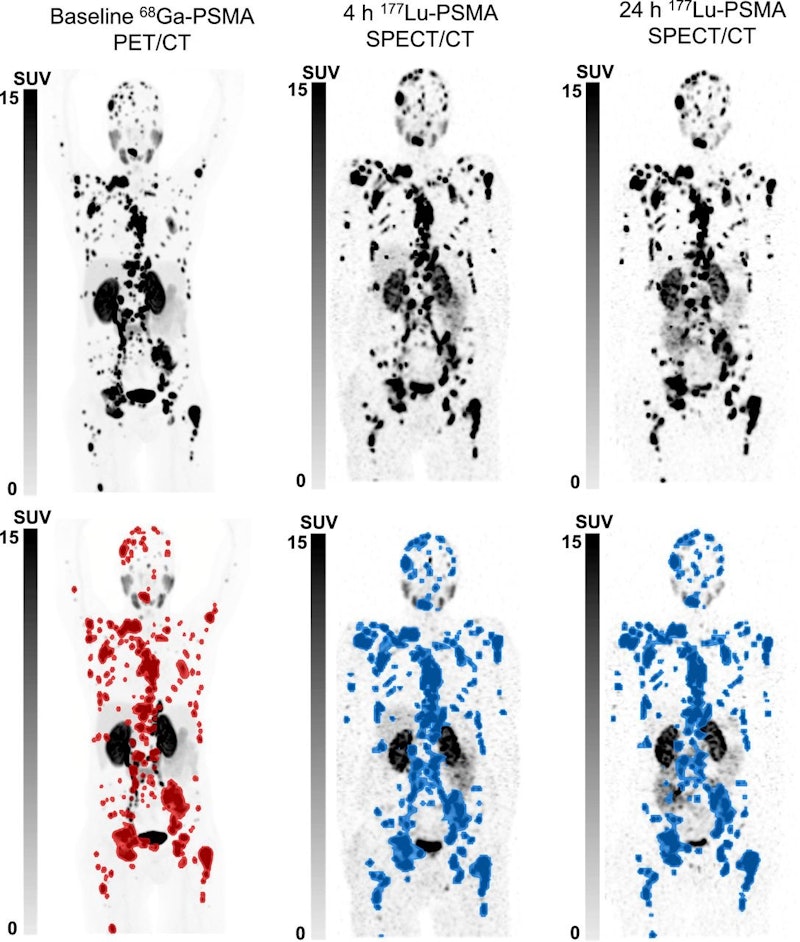 SPECT/CT predicts treatment response in Pluvicto patients | AuntMinnie