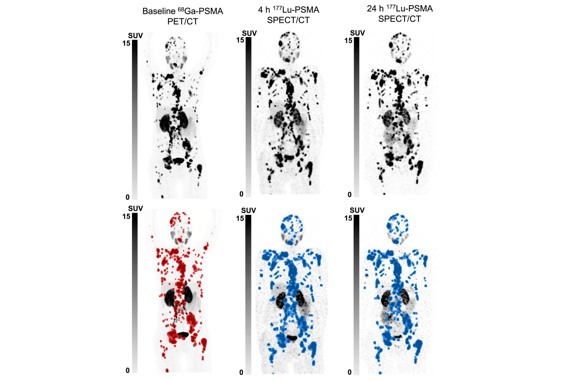 Pluvicto Spect Ct Response Thumbnail