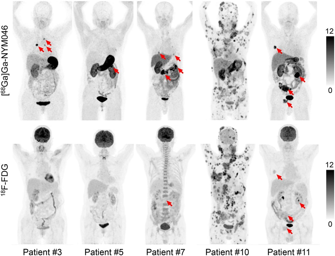 Representative maximum-intensity projections of five patients (patients 3, 5, 7, 10, and 11) comparing Ga-68 NYM046 and F-18 FDG. Both tracers showed specific retention in bone and lymph node metastases (patients 10 and 11). Ga-68 NYM046 PET/CT outperformed F-18 FDG PET/CT in detecting primary tumors, lung metastases, and pleural metastases (patients 3, 5, 7, and 11). Image available for republishing under Creative Commons license (CC BY 4.0 DEED, Attribution 4.0 International) and courtesy of the Journal of Nuclear Medicine.