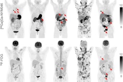 Representative maximum-intensity projections of five patients (patients 3, 5, 7, 10, and 11) comparing Ga-68 NYM046 and F-18 FDG. Both tracers showed specific retention in bone and lymph node metastases (patients 10 and 11). Ga-68 NYM046 PET/CT outperformed F-18 FDG PET/CT in detecting primary tumors, lung metastases, and pleural metastases (patients 3, 5, 7, and 11). Image available for republishing under Creative Commons license (CC BY 4.0 DEED, Attribution 4.0 International) and courtesy of the Journal of Nuclear Medicine.