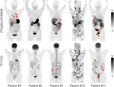 Репрезентативные проекции максимальной интенсивности пяти пациентов (пациенты 3, 5, 7, 10 и 11), сравнивающие Ga-68 NYM046 и F-18 FDG. Оба индикатора показали специфическое удержание в метастазах костей и лимфатических узлов (пациенты 10 и 11). Ga-68 NYM046 PET/CT превзошел F-18 FDG PET/CT в обнаружении первичных опухолей, метастазов в легких и плевральных метастазов (пациенты 3, 5, 7 и 11). Изображение доступно для перепечатки по лицензии Creative Commons (CC BY 4.0 DEED, Attribution 4.0 International) и любезно предоставлено Journal of Nuclear Medicine.