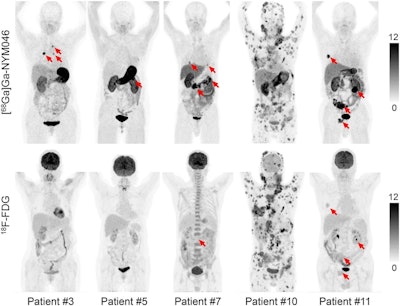 Representative maximum-intensity projections of five patients (patients 3, 5, 7, 10, and 11) comparing Ga-68 NYM046 and F-18 FDG. Both tracers showed specific retention in bone and lymph node metastases (patients 10 and 11). Ga-68 NYM046 PET/CT outperformed F-18 FDG PET/CT in detecting primary tumors, lung metastases, and pleural metastases (patients 3, 5, 7, and 11). Image available for republishing under Creative Commons license (CC BY 4.0 DEED, Attribution 4.0 International) and courtesy of the Journal of Nuclear Medicine.