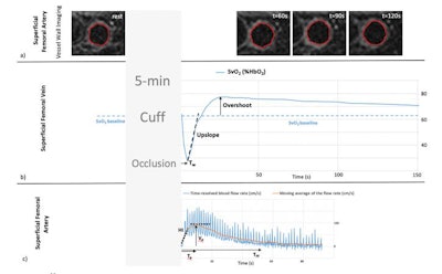 Cuff occlusion paradigm shows the following: (a) Cross-sectional images of the femoral artery that were used to draw regions of interest before (rest) and after cuff occlusion (at three different time points) to determine flow mediated dilation; (b) Femoral vein oxygen saturation (SvO2) plotted vs time after cuff release. SvO2 is derived from the difference between venous and arterial signal phase. (Tw = washout time); and (c) Average blood flow velocity-time curve in the femoral artery. (HI = hyperemic index; Vp = peak velocity; Tp = time to peak velocity; TFF = time of forward flow). Image courtesy of the RSNA.
