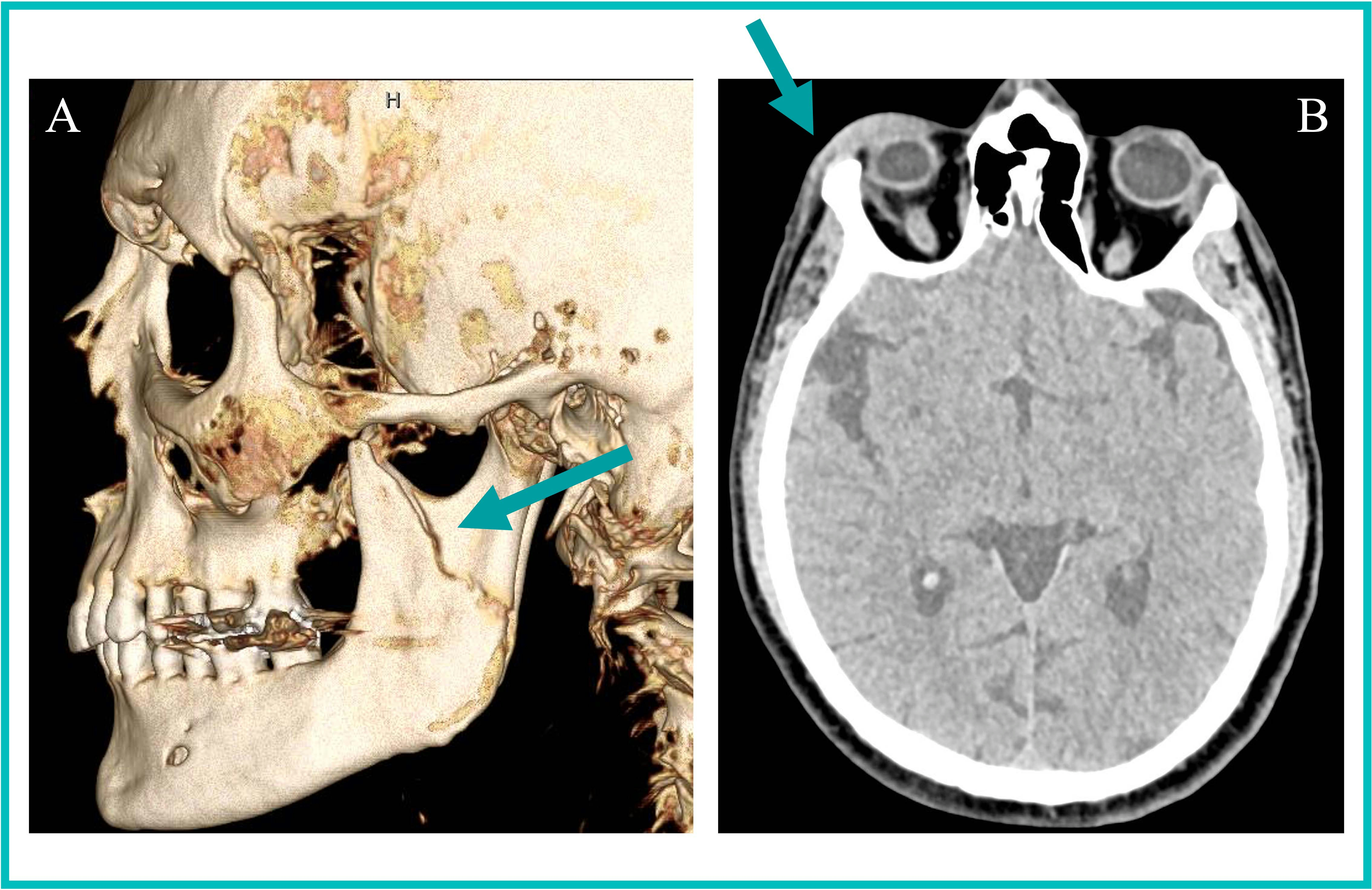 35-year-old transgender woman presents with (A) a 3D CT reformation of the face in the sagittal plane showing a left mandibular fracture (arrow). (B) An axial head CT image from one of three head CT studies over the last two years reveals right periorbital soft tissue swelling (arrow). The radiologist reader suspected intimate partner violence based on radiology reports, which was subsequently confirmed through clinical note examination. Image courtesy of the RSNA.
