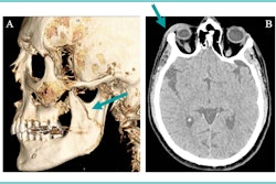 35-year-old transgender woman presents with (A) a 3D CT reformation of the face in the sagittal plane showing a left mandibular fracture (arrow). (B) An axial head CT image from one of three head CT studies over the last two years reveals right periorbital soft tissue swelling (arrow). The radiologist reader suspected intimate partner violence based on radiology reports, which was subsequently confirmed through clinical note examination. Image courtesy of the RSNA.