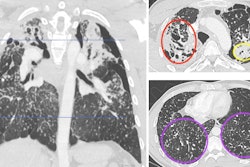 Contrast-enhanced chest CT shows upper predominant fibrosis/lung scarring (red oval), solid masses adjacent to a left-sided pneumothorax (yellow oval) and diffuse silicotic nodules (purple circle). This patient had a history of working in the countertop-cutting industry (15 years), smoking cigarettes (10 pack years), and active tuberculosis (treated 7 years prior and excluded at the time of this image with laboratory testing). Image courtesy of the RSNA.