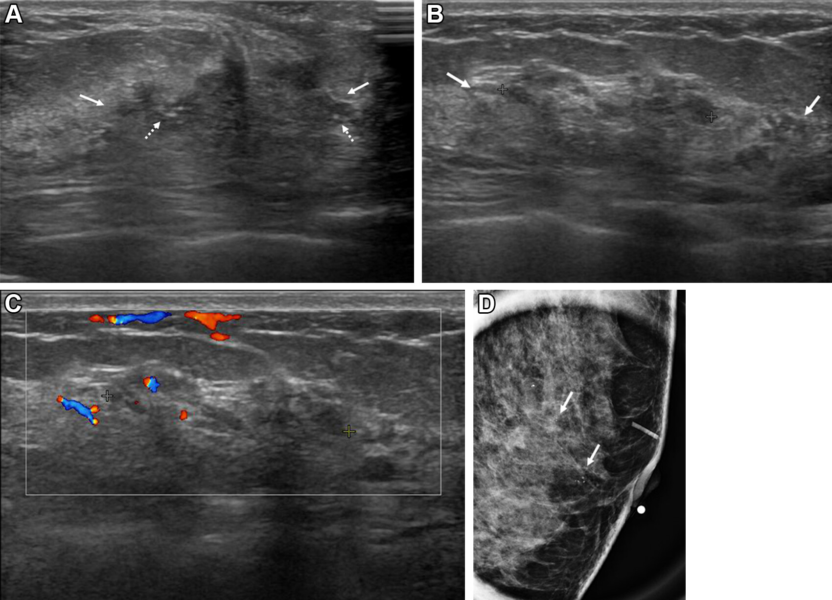 Images depict a 43-year-old woman with a malignant nonmass lesion that was diagnosed as microinvasive ductal carcinoma. (A) Transverse and (B) longitudinal ultrasound images show a hypoechoic nonmass lesion (solid arrows) with segmental distribution in the left breast. The lesion has associated calcifications (dashed arrows in A). (C) Longitudinal color Doppler ultrasound image shows high vascularity. (D) Magnified image in the mediolateral oblique view from screening mammography shows grouped calcifications (arrows), which are considered a mammographic correlate of the ultrasound-detected nonmass lesion (A radiopaque marker attached to the skin is visible in the image because the mammographic exam was performed after screening breast ultrasound). Ultrasound-guided core needle biopsy and pathologic examination revealed ductal carcinoma in situ, but the lesion was upgraded to microinvasive ductal carcinoma at subsequent surgery (2.5-cm ductal carcinoma in situ, histologic grade II, estrogen receptor-positive, progesterone receptor-positive, human epidermal growth factor receptor type 2-negative).
