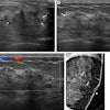 Images depict a 43-year-old woman with a malignant non-mass lesion that was diagnosed as microinvasive ductal carcinoma. (A) Transverse and (B) longitudinal ultrasound images show a hypoechoic non-mass lesion (solid arrows) with segmental distribution in the left breast. The lesion has associated calcifications (dashed arrows in A). (C) Longitudinal color Doppler ultrasound image shows high vascularity. (D) Magnified image in the mediolateral oblique view from screening mammography shows grouped calcifications (arrows), which are considered a mammographic correlate of the ultrasound-detected non-mass lesion (A radiopaque marker attached to the skin is visible in the image because the mammographic exam was performed after screening breast ultrasound). Ultrasound-guided core needle biopsy and pathologic examination revealed ductal carcinoma in situ, but the lesion was upgraded to microinvasive ductal carcinoma at subsequent surgery (2.5-cm ductal carcinoma in situ, histologic grade II, estrogen receptor-positive, progesterone receptor-positive, human epidermal growth factor receptor type 2-negative).