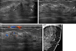 Images depict a 43-year-old woman with a malignant nonmass lesion that was diagnosed as microinvasive ductal carcinoma. (A) Transverse and (B) longitudinal ultrasound images show a hypoechoic nonmass lesion (solid arrows) with segmental distribution in the left breast. The lesion has associated calcifications (dashed arrows in A). (C) Longitudinal color Doppler ultrasound image shows high vascularity. (D) Magnified image in the mediolateral oblique view from screening mammography shows grouped calcifications (arrows), which are considered a mammographic correlate of the ultrasound-detected nonmass lesion (A radiopaque marker attached to the skin is visible in the image because the mammographic exam was performed after screening breast ultrasound). Ultrasound-guided core needle biopsy and pathologic examination revealed ductal carcinoma in situ, but the lesion was upgraded to microinvasive ductal carcinoma at subsequent surgery (2.5-cm ductal carcinoma in situ, histologic grade II, estrogen receptor-positive, progesterone receptor-positive, human epidermal growth factor receptor type 2-negative).