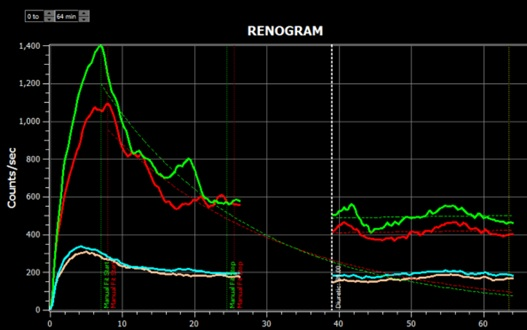 Results of a renogram displayed by the Hybrid Viewer 7.0 software.