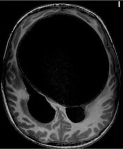 An axial T1-weighted MRI scan of a hydatid cyst. Clinical images courtesy of Carlos F. Ugas Chacape, MD.
