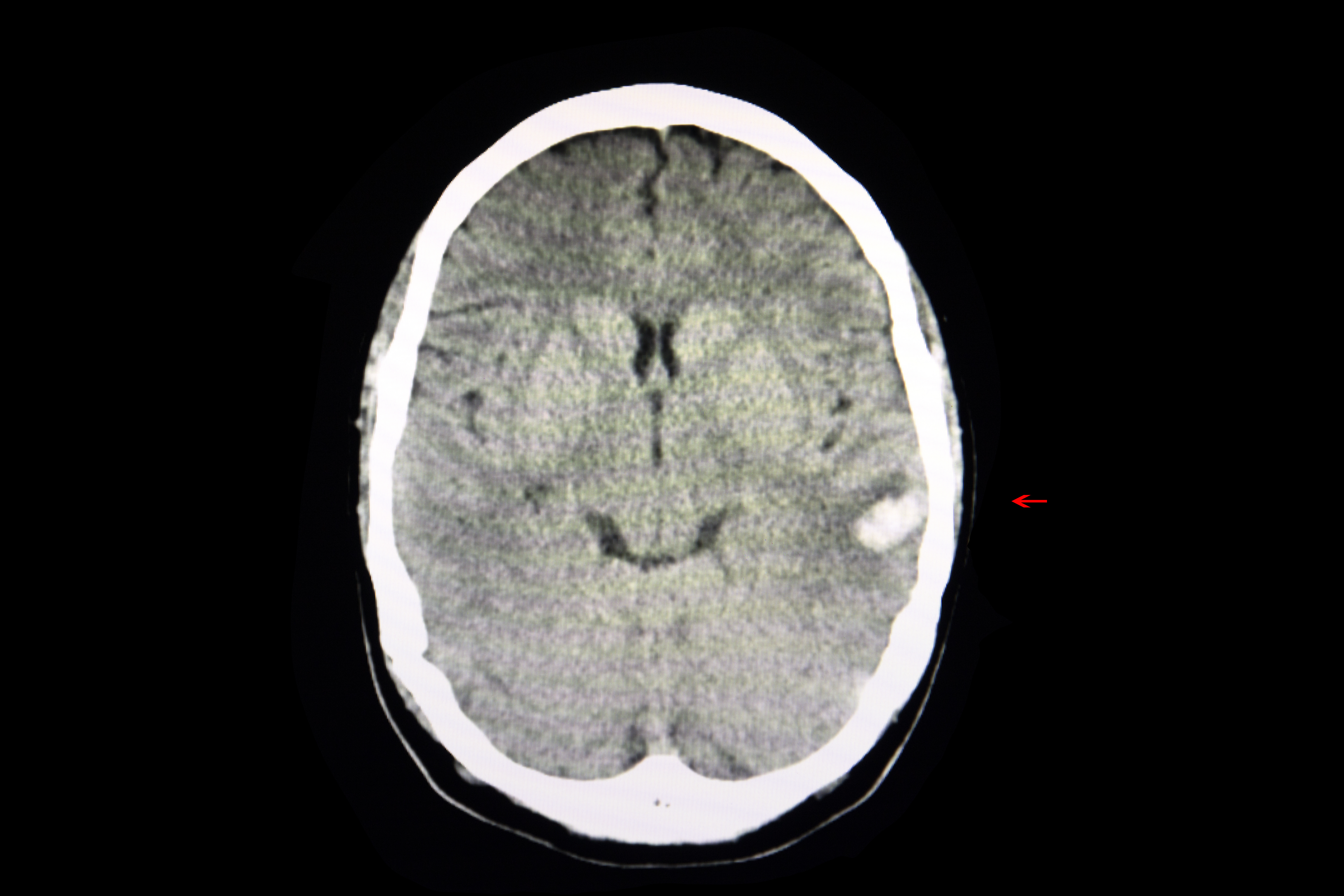 Ct Intracerebral Hemorrhage