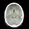 Ct Intracerebral Hemorrhage