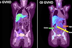 F-18 FLT-PET imaging of gastrointestinal GVHD. Examples of F-18 FLT uptake in a participant with no GVHD (left) and a participant with acute GVHD and uptake in the jejunum and ileum (right). Arrows denote increased uptake in the GI tract. Image available for republishing under Creative Commons license (CC BY 4.0 DEED, Attribution 4.0 International) and courtesy of RSNA.