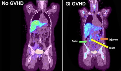 F-18 FLT-PET imaging of gastrointestinal GVHD. Examples of F-18 FLT uptake in a participant with no GVHD (left) and a participant with acute GVHD and uptake in the jejunum and ileum (right). Arrows denote increased uptake in the GI tract. Image available for republishing under Creative Commons license (CC BY 4.0 DEED, Attribution 4.0 International) and courtesy of RSNA.
