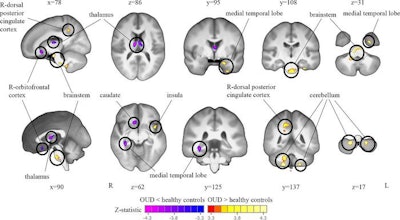 Tensor-based morphometry (TBM) analysis of T1-weighted MRI scans shows a comparison of brain volumes in participants with opioid use disorder (OUD) and healthy control participants. Widespread volume differences are observed between participants with OUD and healthy controls when accounting for total brain volume. Specifically, the bilateral thalamus, right caudate and orbitofrontal cortex, and right medial temporal lobe show lower volume in participants with OUD compared with healthy controls. The left medial temporal lobe, brainstem, bilateral cerebellum, left insula, and right dorsal posterior cingulate cortex show greater volume in those with OUD compared with healthy controls. All results are shown at p < 0.05, corrected for multiple comparisons. The color scale indicates the z statistic, whereby blue to pink represents smaller volumes in the OUD group compared with healthy controls, and red to yellow represents larger volumes in the OUD group compared with healthy controls. L = left, R = right. Image and caption courtesy of the RSNA.