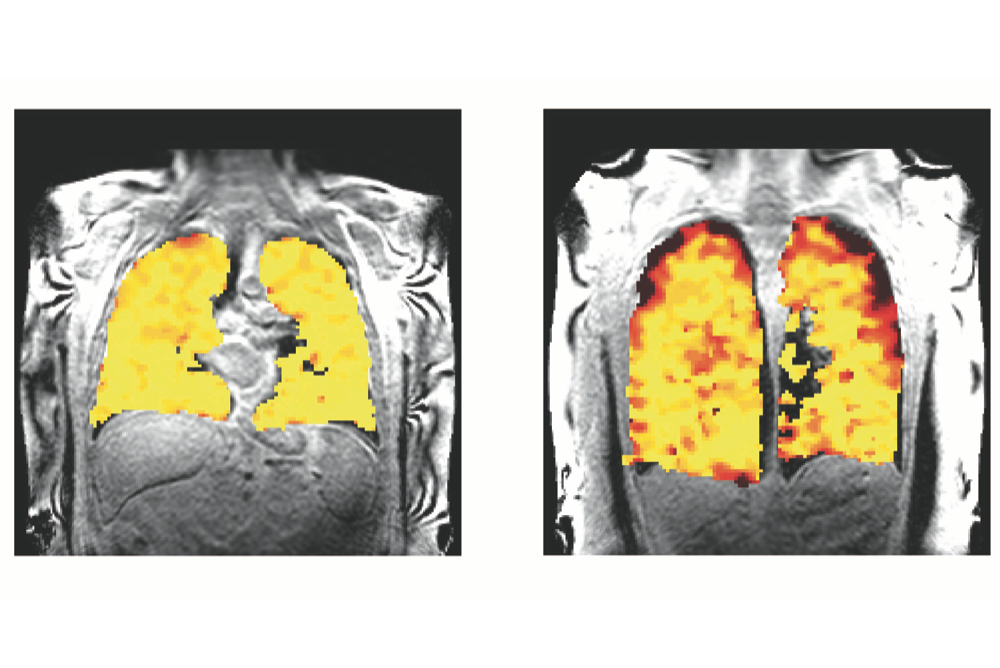 Lung Function Mri Showing Measurements In Lung Transplant Recipients Thumbnail