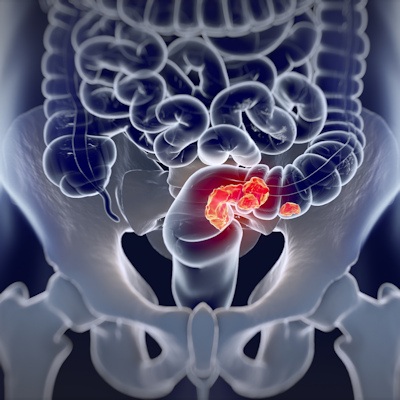 Am 2021 10 04 18 46 2240 Colorectal Cancer 400