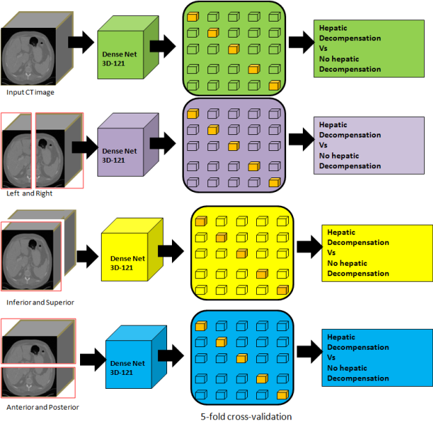 Researchers have developed a CT-based deep-learning model for predicting liver decompensation in PSC patients. Pictured is the team's diagram of the pipeline it developed for distinguishing between decompensation and no decompensation is presented in various planes. Image courtesy of Yashbir Singh, PhD.