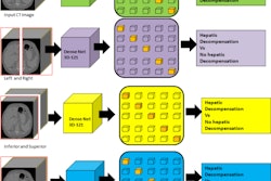 Researchers have developed a CT-based deep-learning model for predicting liver decompensation in PSC patients. Pictured is the team's diagram of the pipeline it developed for distinguishing between decompensation and no decompensation is presented in various planes. Image courtesy of Yashbir Singh, PhD.