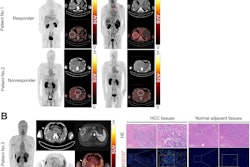 PET/CT images of F-18 AlF-NOTA-BCP137 in patients with hepatocellular carcinoma (HCC) and immunofluorescence analysis of patient tissues. (A) F-18 AlF-NOTA-BCP137 PET/CT images before and after immunotherapy for patient 1 and patient 2. (B) F-18 AlF-NOTA-BCP137 PET/CT and MR images of patient 3 (left panels) after one cycle of immunotherapy. PET images showed higher uptake by tumor and spleen, and PET result was evaluated as positive; therefore, the patient was considered to be responder to treatment and underwent surgical resection. Representative images of hematoxylin and eosin (HE) staining and multiplex immunofluorescence of CD8 and CD137 (right panels) in HCC tumor and adjacent normal tissues of patient 3 after surgery. Nuclei were stained with 4′,6-diamidino-2-phenylindole. Primary tumors are indicated by white arrows, and increased thyroid uptake is indicated by red arrow in PET images. Image courtesy of the Journal of Nuclear Medicine.