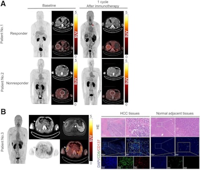 PET/CT images of F-18 AlF-NOTA-BCP137 in patients with hepatocellular carcinoma (HCC) and immunofluorescence analysis of patient tissues. (A) F-18 AlF-NOTA-BCP137 PET/CT images before and after immunotherapy for patient 1 and patient 2. (B) F-18 AlF-NOTA-BCP137 PET/CT and MR images of patient 3 (left panels) after one cycle of immunotherapy. PET images showed higher uptake by tumor and spleen, and PET result was evaluated as positive; therefore, the patient was considered to be responder to treatment and underwent surgical resection. Representative images of hematoxylin and eosin (HE) staining and multiplex immunofluorescence of CD8 and CD137 (right panels) in HCC tumor and adjacent normal tissues of patient 3 after surgery. Nuclei were stained with 4′,6-diamidino-2-phenylindole. Primary tumors are indicated by white arrows, and increased thyroid uptake is indicated by red arrow in PET images. Image courtesy of the Journal of Nuclear Medicine.