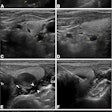 Ultrasound images depict a 63-year-old man who underwent radiofrequency ablation (RFA) for the treatment of secondary hyperparathyroidism. (A–D) 2D images show four hyperplastic parathyroid glands on the right and left sides (marked with crosshairs). The numbers near the crosshairs represent the number of measured trails. (E) Ultrasound-guided infusion of isolation fluid (arrowheads) around the hyperplastic parathyroid gland to protect vital organs such as the trachea (Tr), carotid arteries (CA), and recurrent laryngeal nerve pathway area (arrow). F) Ultrasound-guided RFA of the hyperplastic parathyroid gland. (G) Immediate postoperative contrast-enhanced ultrasound shows no contrast enhancement in the ablation area. The ablation procedures for the other three parathyroid glands were the same as those described above. Image courtesy of the RSNA,