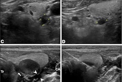Ultrasound images depict a 63-year-old man who underwent radiofrequency ablation (RFA) for the treatment of secondary hyperparathyroidism. (A–D) 2D images show four hyperplastic parathyroid glands on the right and left sides (marked with crosshairs). The numbers near the crosshairs represent the number of measured trails. (E) Ultrasound-guided infusion of isolation fluid (arrowheads) around the hyperplastic parathyroid gland to protect vital organs such as the trachea (Tr), carotid arteries (CA), and recurrent laryngeal nerve pathway area (arrow). F) Ultrasound-guided RFA of the hyperplastic parathyroid gland. (G) Immediate postoperative contrast-enhanced ultrasound shows no contrast enhancement in the ablation area. The ablation procedures for the other three parathyroid glands were the same as those described above. Image courtesy of the RSNA,