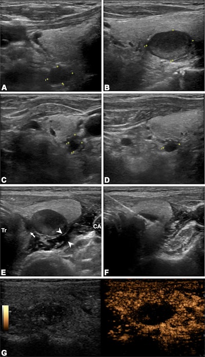 Ultrasound images depict a 63-year-old man who underwent radiofrequency ablation (RFA) for the treatment of secondary hyperparathyroidism. (A–D) 2D images show four hyperplastic parathyroid glands on the right and left sides (marked with crosshairs). The numbers near the crosshairs represent the number of measured trails. (E) Ultrasound-guided infusion of isolation fluid (arrowheads) around the hyperplastic parathyroid gland to protect vital organs such as the trachea (Tr), carotid arteries (CA), and recurrent laryngeal nerve pathway area (arrow). F) Ultrasound-guided RFA of the hyperplastic parathyroid gland. (G) Immediate postoperative contrast-enhanced ultrasound shows no contrast enhancement in the ablation area. The ablation procedures for the other three parathyroid glands were the same as those described above. Image courtesy of the RSNA,