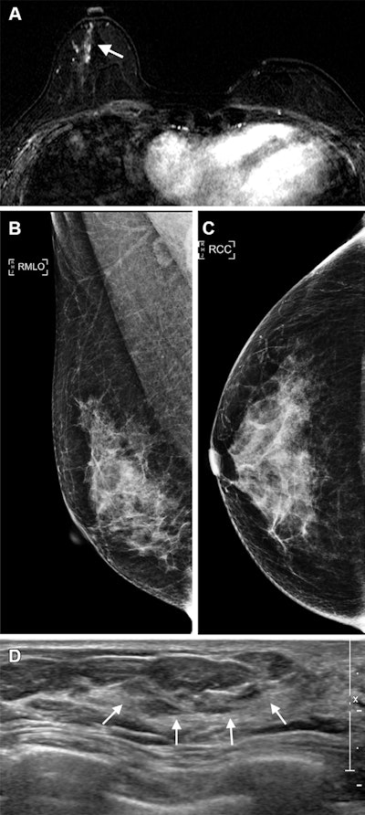 Images in a 40-year-old woman who underwent breast-conserving surgery for left breast cancer and a surveillance breast MRI examination 25 months after surgery. (A) Axial T1-weighted contrast-enhanced subtraction MRI scan shows a newly developed nonmass enhancement (arrow) in the right central breast. (B) The right mediolateral oblique (RMLO) and (C) right craniocaudal (RCC) mammograms, obtained on the same day, show heterogeneously dense breast tissue that was assessed as being negative for cancer. (D) MRI-directed US image in the radial plane shows a corresponding 14-mm nonmass lesion (arrows) in the right lower outer breast, which was confirmed estrogen receptor-positive, progesterone receptor–positive, and human epidermal growth factor receptor 2-negative T1N0 mucinous carcinoma. Image and caption courtesy of the RSNA.