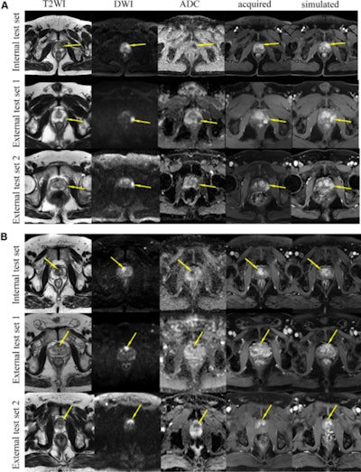 Axial prostate MRI scans. The simulated contrast-enhanced axial prostate images were comparable with the acquired contrast-enhanced images. Example images from the internal test set and the two external test sets show (A) a lesion in the peripheral zone (arrows) and (B) a lesion in the transition zone (arrows). Notably, there are visual differences between the simulated and acquired contrast-enhanced images regarding the degree of lesion enhancement and the measurement of lesion size (see Fig S4). ADC = apparent diffusion coefficient, DWI = diffusion-weighted imaging, T2WI = T2-weighted imaging. Images and caption courtesy of the RSNA.