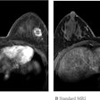 Ultrafast and standard MRI in a 30-year-old woman with triple-negative invasive ductal carcinoma. (A) Ultrafast MRI taken 16.8 seconds after contrast agent injection. (B) Standard MRI taken 58.8 seconds after contrast agent injection. Both images show an oval-shaped, irregular marginated, rim-enhancing mass in the left outer breast. For 3D tumor segmentation, the entire enhanced tumor margins were drawn from top to bottom of each tumor in axial views of U2 phase postcontrast ultrafast MRI and the initial phase postcontrast standard MRI. Among the 14 ultrafast images, U1 is the first phase in which the signal intensity of the hotspot region of interest of the tumor is 10% higher than the average signal intensity of unenhanced images. U2 is the immediate next phase of U1 and the well-established tumor enhancement time.