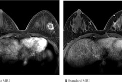 Ultrafast and standard MRI in a 30-year-old woman with triple-negative invasive ductal carcinoma. (A) Ultrafast MRI taken 16.8 seconds after contrast agent injection. (B) Standard MRI taken 58.8 seconds after contrast agent injection. Both images show an oval-shaped, irregular marginated, rim-enhancing mass in the left outer breast. For 3D tumor segmentation, the entire enhanced tumor margins were drawn from top to bottom of each tumor in axial views of U2 phase postcontrast ultrafast MRI and the initial phase postcontrast standard MRI. Among the 14 ultrafast images, U1 is the first phase in which the signal intensity of the hotspot region of interest of the tumor is 10% higher than the average signal intensity of unenhanced images. U2 is the immediate next phase of U1 and the well-established tumor enhancement time.