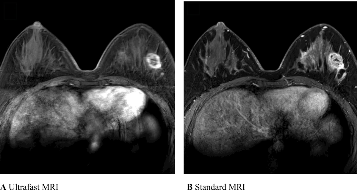 Ultrafast MRI exam bests standard MRI for classifying breast cancers ...